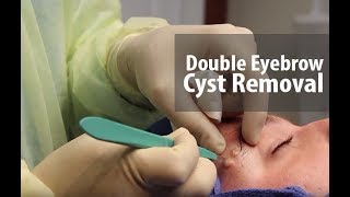 Double Eyebrow Cyst