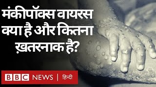 Monkey Pox Virus : मंकी पॉक्स वायरस क्या है, कितना ख़तरनाक है और इसके लक्षण क्या-क्या हैं? (BBC)