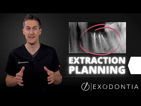 How To Extract Teeth Successfully Every Time | OnlineExodontia.com