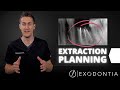 How To Extract Teeth Successfully Every Time OnlineExodontia Com