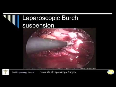 Laparoscopic Surgery for Stress Urinary Incontinence