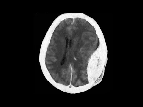 Les Traumatismes Crâniens - partie 02