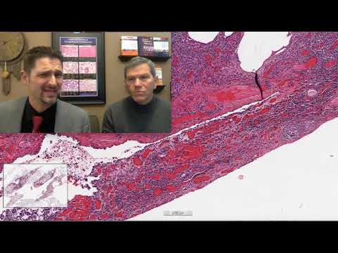 Pattern 3 - Cellular Infiltrates, CTD-Associated ILD (Top 25 Pearls Series, Topic 3, Pearl 5)