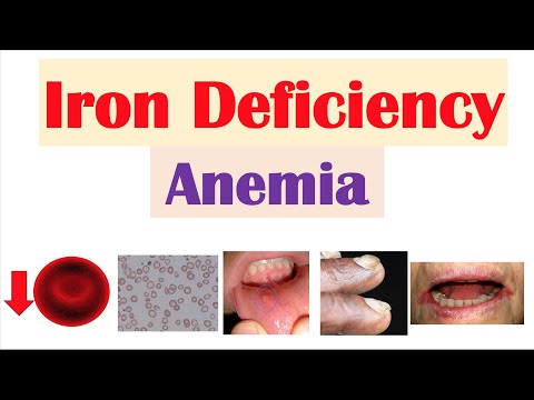 Iron-Deficiency Anemia (Overview) | Causes, Pathophysiology, Signs & Symptoms, Diagnosis, Treatment