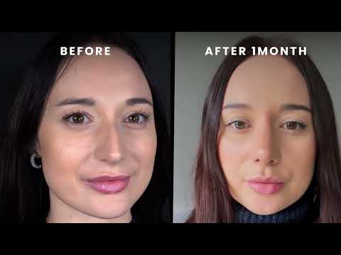 Real Rhinoplasty Results: Before & After Transformations