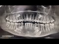 12 Impacted Teeth Removed in One Go - World Record