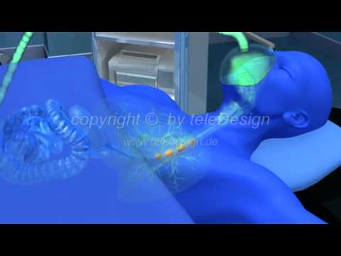 GN 087 Narkose Wuergereflex - PAL 16:9 / GN 087 anesthesia stomach reflex - PAL 16:9