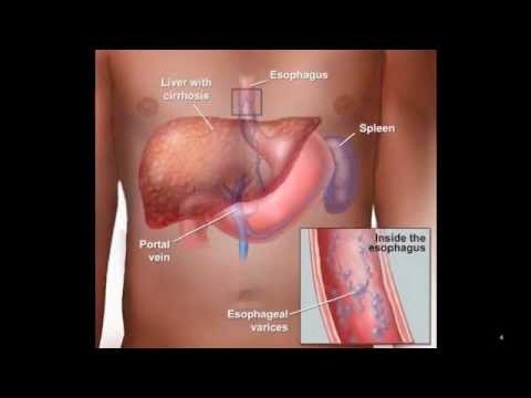 Upper Gastrointestinal Bleed - Hematemesis - YouTube