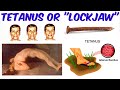 Tetanus - "Lockjaw"