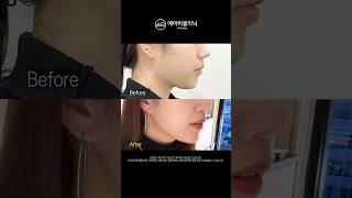 울쎄라 통증 땜에 미뤘다면 이렇게 해보세요!✅