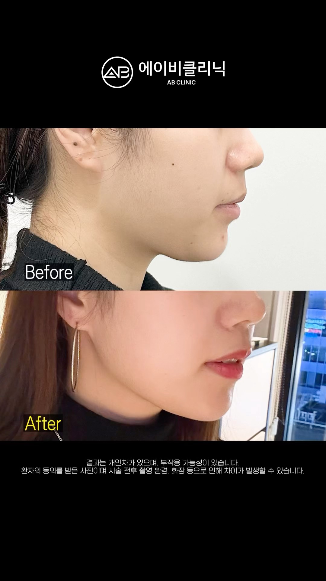 울쎄라 통증 땜에 미뤘다면 이렇게 해보세요!✅