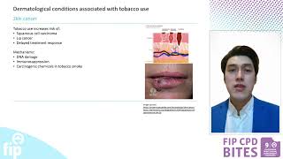 Episode 4: Tobacco use and skin health: What pharmacists need to know.