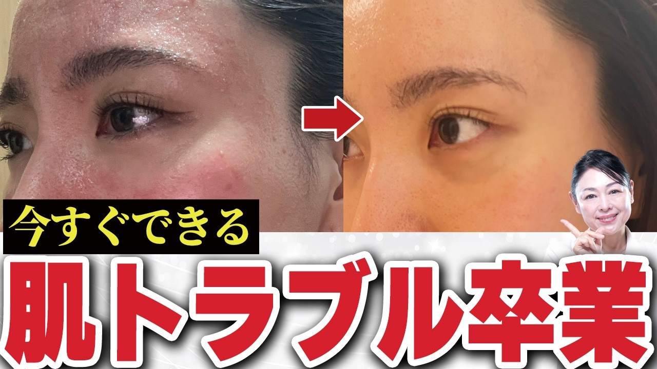 【絶対よくなる】バリア機能を回復させるスキンケアの３つのポイント