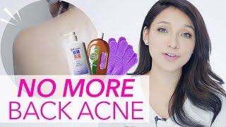 Get Rid of Back Acne/Pimple (in ONE WEEK)| GDiipa