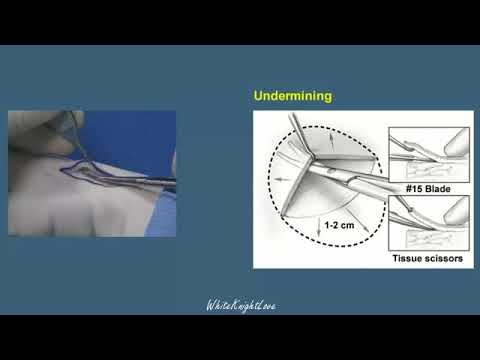 6 3 Undermining   Essential Surgical Skills WhiteKnightLove