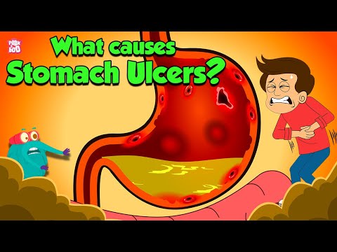 What Causes Stomach Ulcers? | Gastric Ulcers | Peptic Ulcers | Understanding Stomach | Dr. Binocs