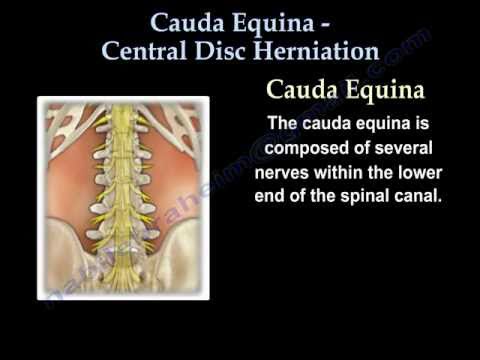 Cauda Equina, hernia de disco central - Todo lo que se necesita saber