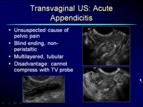 Ultrasound Non Gynecological Findings/ very important / must see