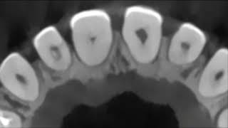 Management of a sclerotic maxillary central incisor associated with a periapical lesion.