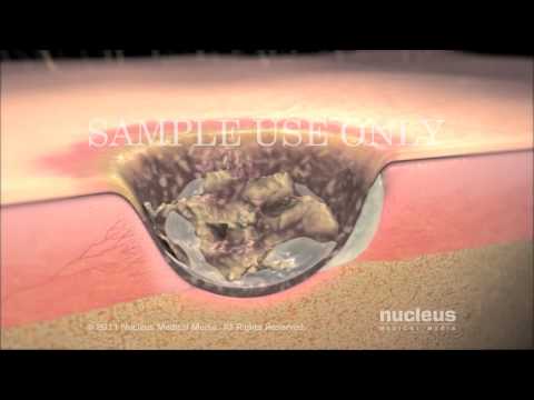 Surgical Debridement - YouTube