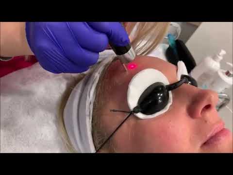 Usuwanie przebarwień laserem pikosekundowym