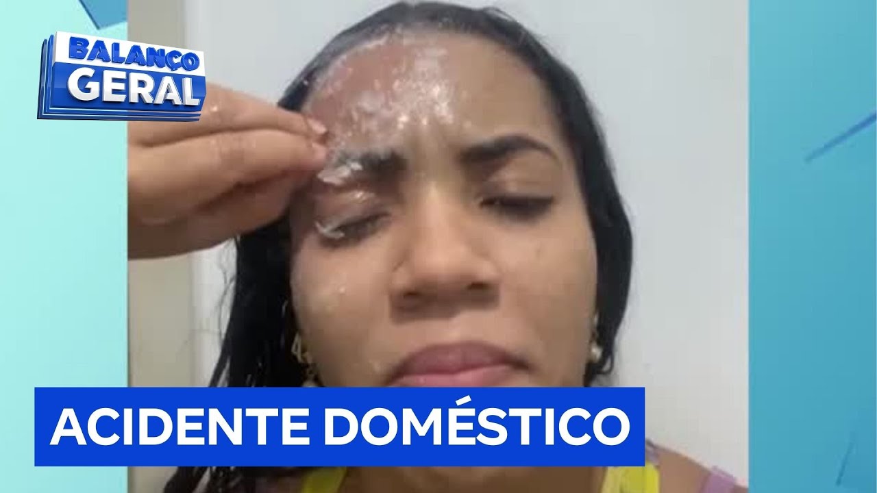 Assistente de compras perde parte da sobrancelha e cílios depois de derrubar cola na cabeça