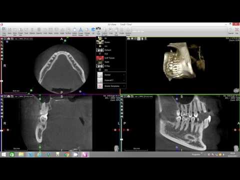 Virtual Endoscope Mandibular Nerve X-Mind Trium