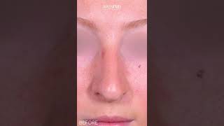 Rhinoplasty Surgery with Dr. Paul Nassif