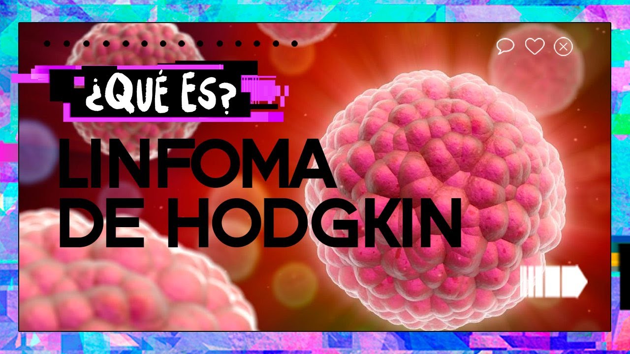 ¿Qué es el linfoma de hodgkin