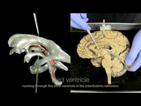 Ventricular System of the Brain