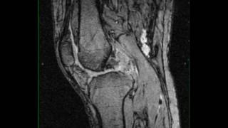Pigmented Villonodular Synovitis, Knee