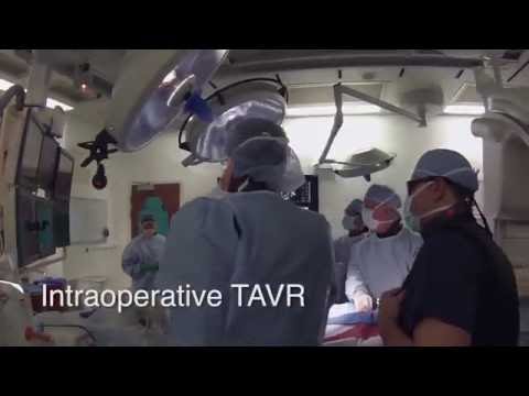 TAVR team