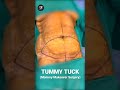 Mommy Makeover Surgery | Tummy Tuck Surgery #tummytuck #mommymakeover #fatreduction #shorts #ytshort