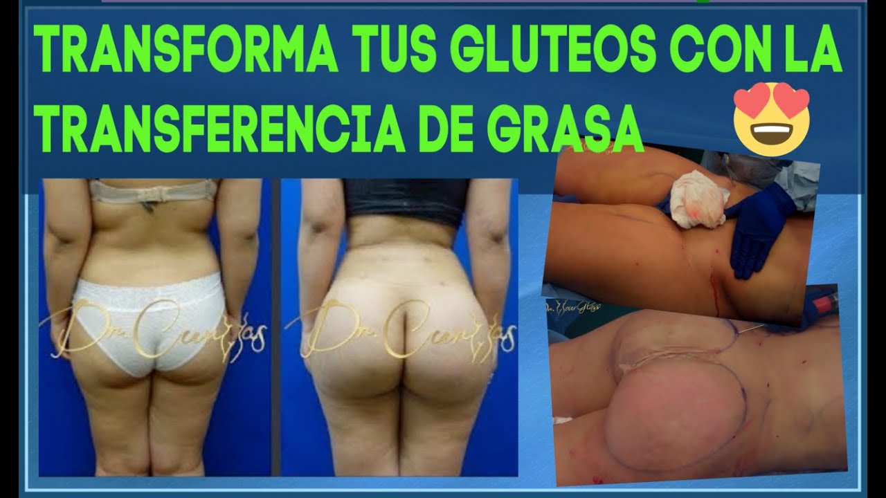 Watch Aumento de Glúteos con Grasa | Antes y Después | BBL | Dr.Cortes Now Aumento de Glúteos con Grasa | Antes y Después | BBL | Dr.Cortes