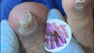 Ep_8466 Ingrown toenail removal 👣 ไม่เอาออก..ทายาก็ไม่หาย 😄 (clip from Thailand)