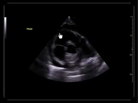 Cardiac Pathology on POCUS: A Guide to Diagnosing Critical Conditions