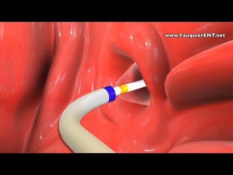 image-What causes a narrow eustachian tube?