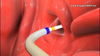 Balloon Eustachian Tube Dilation to Treat Eustachian Tube Dysfunction