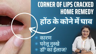Corner Of Lips Cracked Home Remedy| होंठ के किनारे से फटने के कारण, घरेलू उपाय और ईलाज