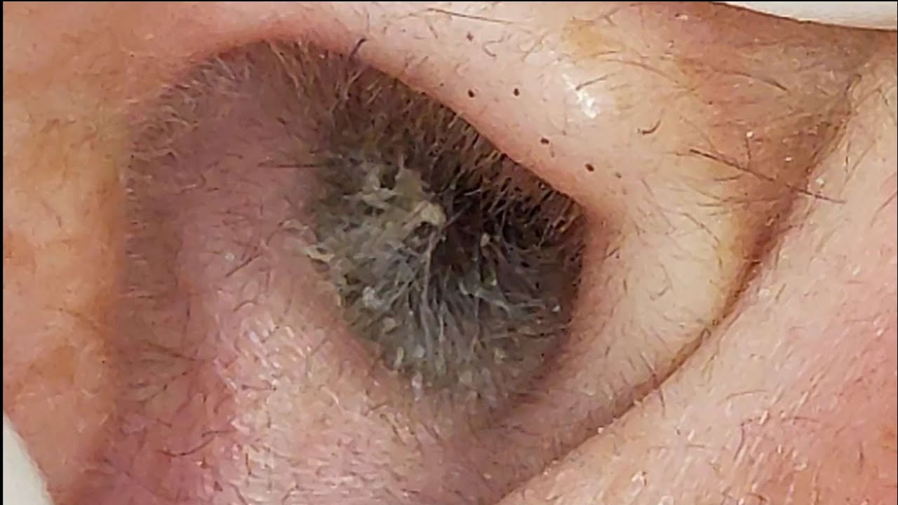 【耳掃除】#159  〜キレイになったと思ったら…奥に…〜  earwax