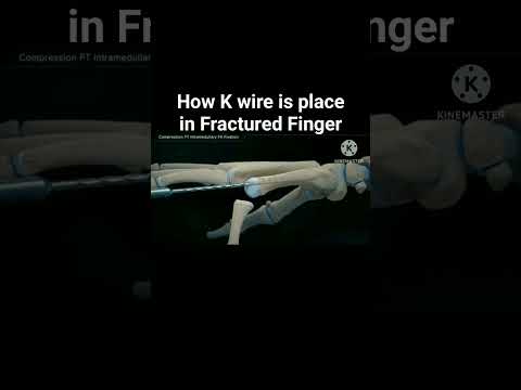 how K wire is place in fractured finger