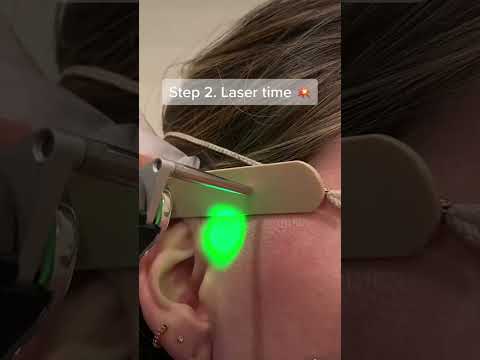 Sideburn laser hair removal at SEV Laser