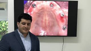 Prótesis fija atornillada de Zr.  sobre Implantes dentales