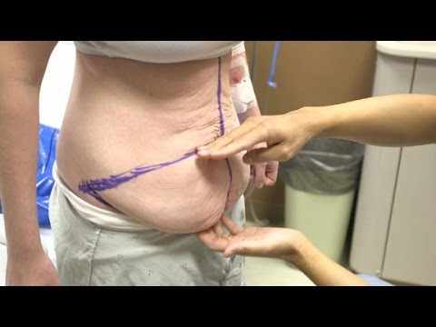 Teen gets tummy tuck to remove 'hang'