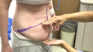 Teen gets tummy tuck to remove 