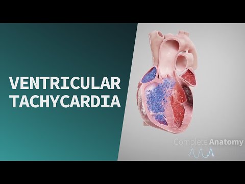 Ventricular Tachycardia