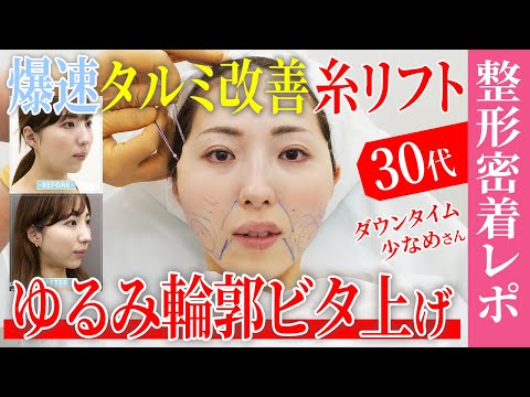 【絶対に失敗できない糸リフト整形密着】タルミを急改善してウェディングフォトを撮りたい30代女子のダウンタイムレポート【ほうれい線改善】湘南美容クリニック