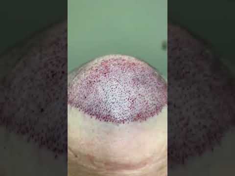FUE Hair Transplant Procedure with 2500 Grafts