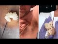 Best Satisfying Pimples Popping Cyst Removal Acne Blackheads Compilation Videos 24