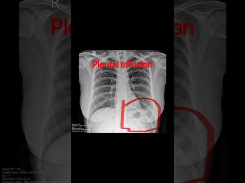 .Normal lung vs Infected lungs 🫁 #lungs #chest #radiology #xray #neet #radiology #medicos #doctor .